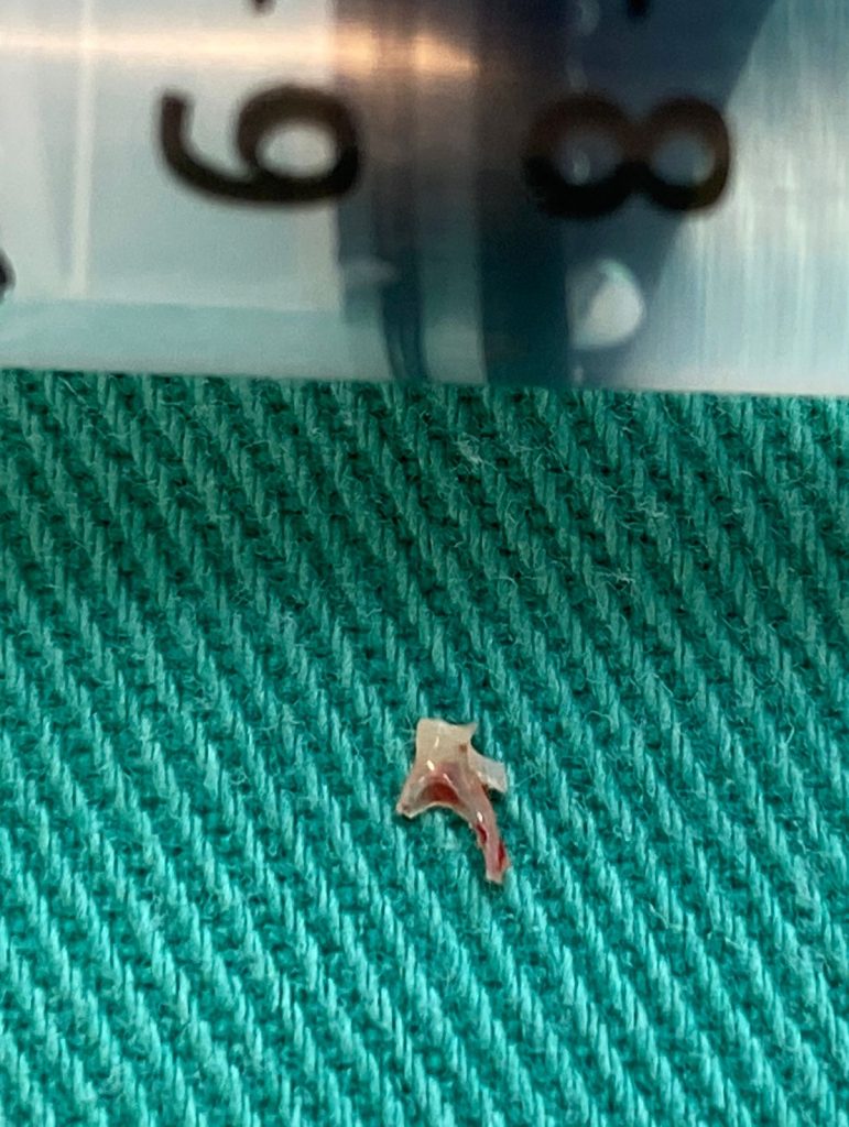 supraestrutura do estribo retirada em cirurgia de Estapedotomia