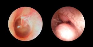 exostose e osteoma