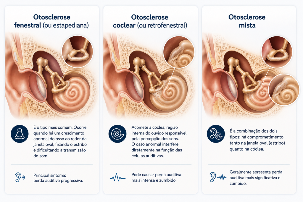 Tipos de otosclerose - infográfico